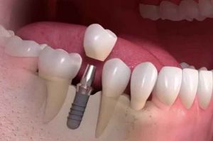 Dental Implant Courses And Dental Implantology Courses in In